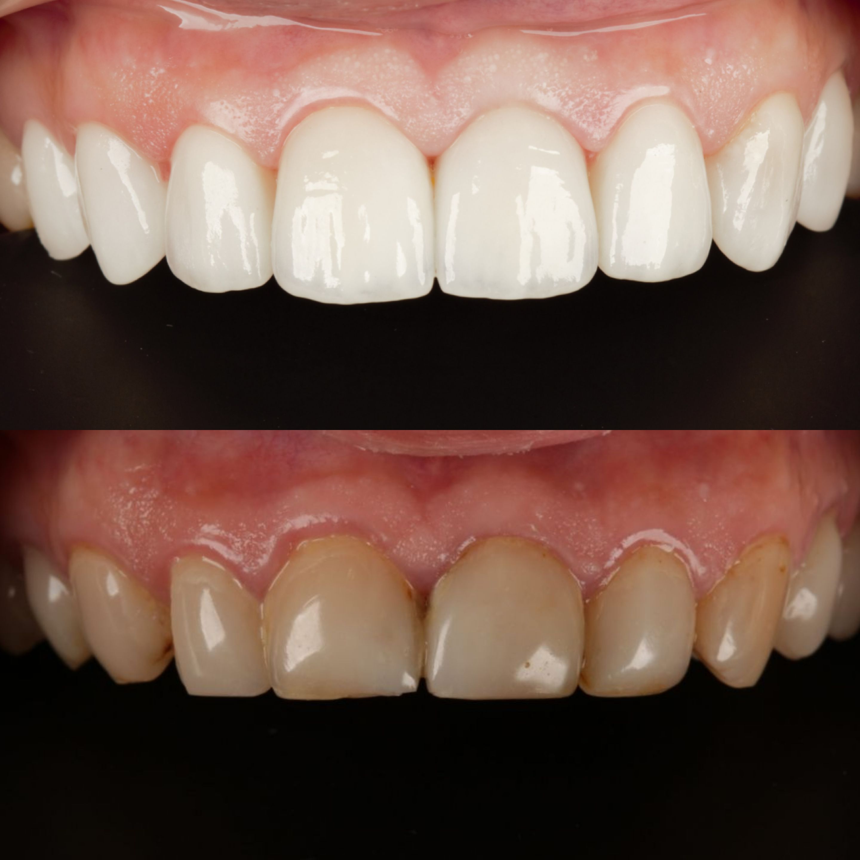 Керамические виниры на передние зубы верхней челюсти
